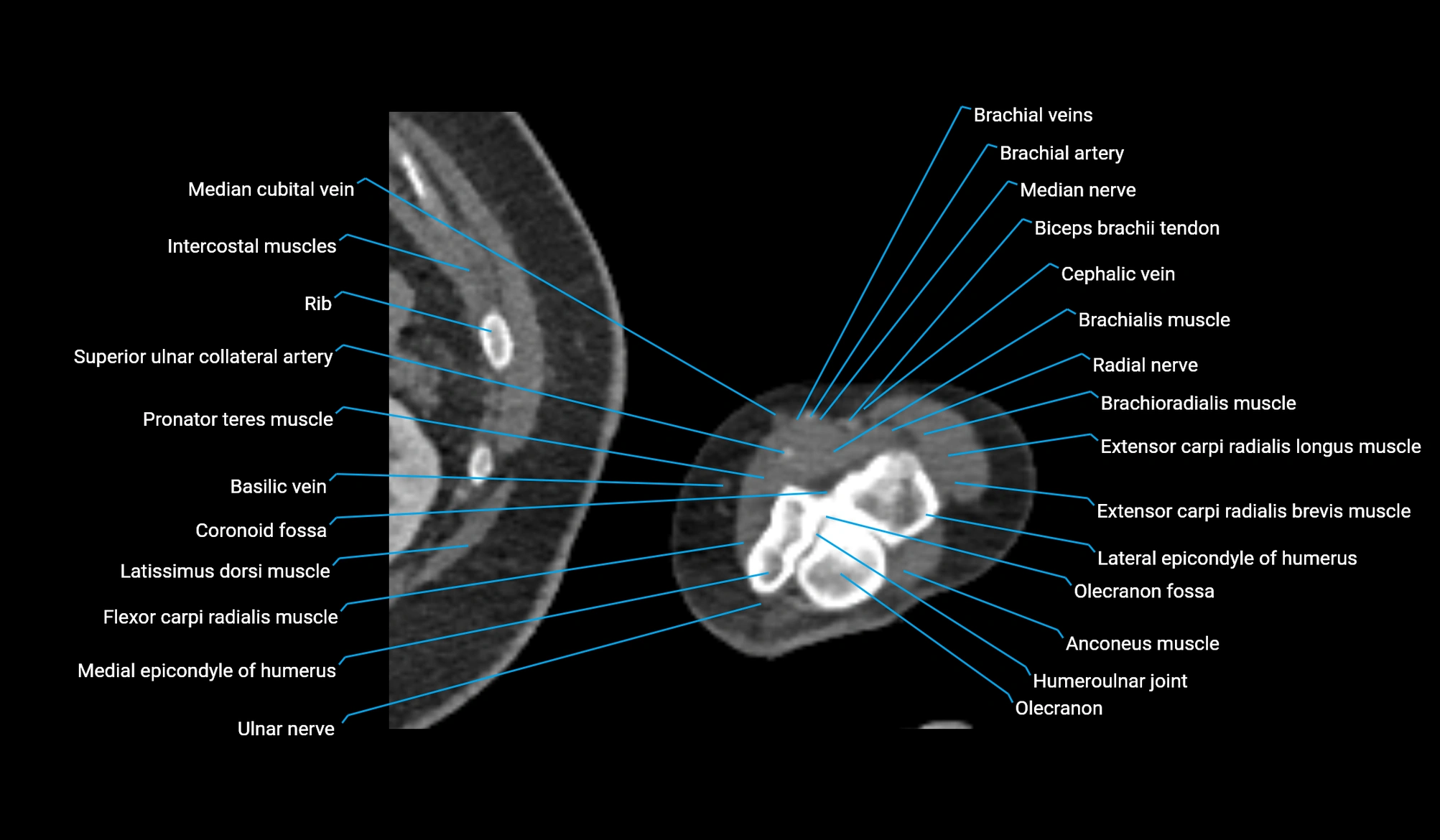 CT upper arm axial  cross sectional anatomy labelled radiology image -00382.webp